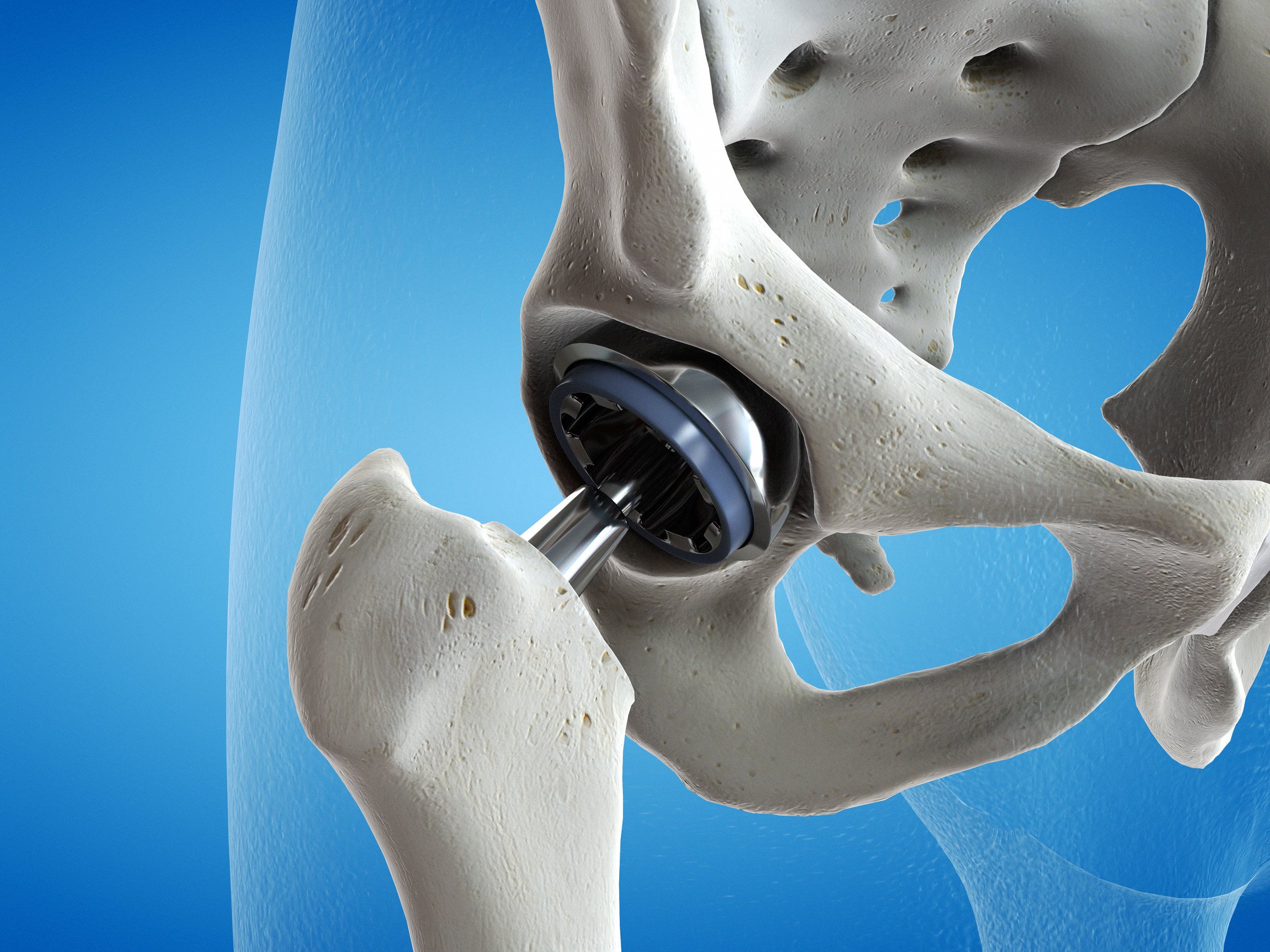 3d rendered illustration of a hip replacement